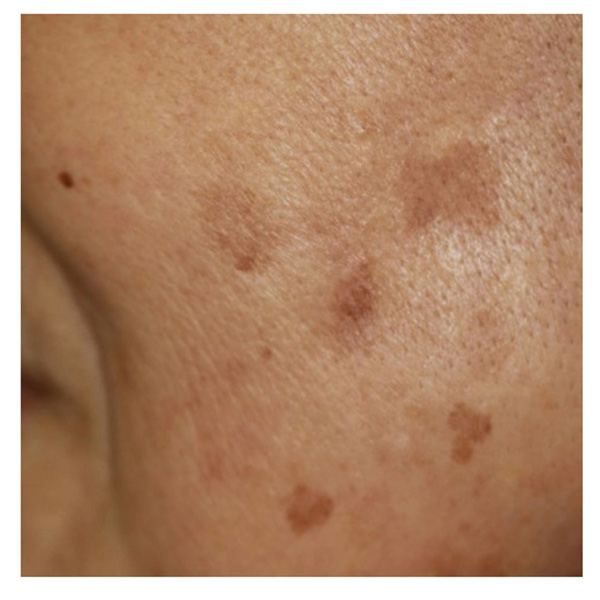 フォトフェイシャル 施行前