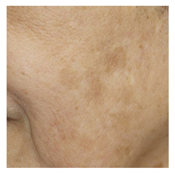 フォトフェイシャル 施行後