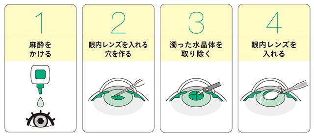 白内障手術の方法