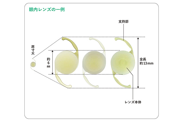 眼内レンズの一例