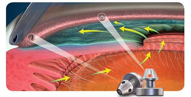 iStent inject W：アイステント・インジェクトW
