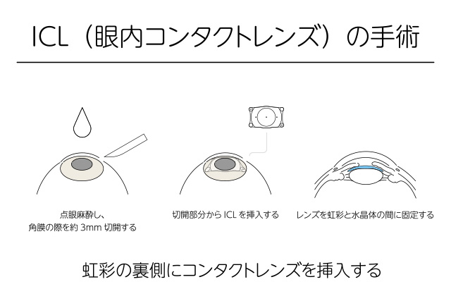 ICL（眼内コンタクトレンズ）の手術