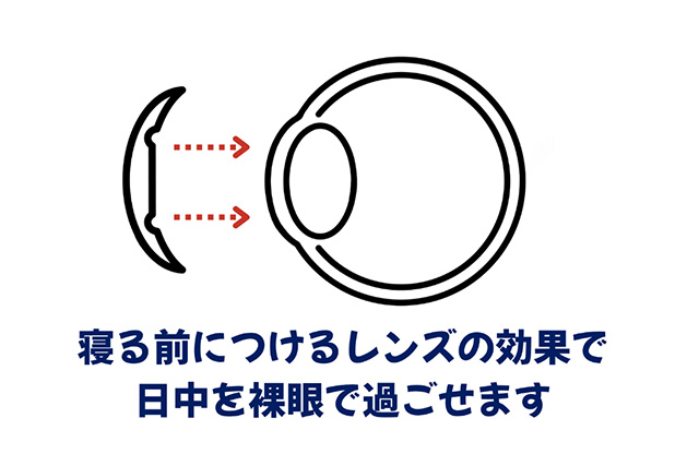 寝る前につけるレンズの効果で日中を裸眼で過ごせます