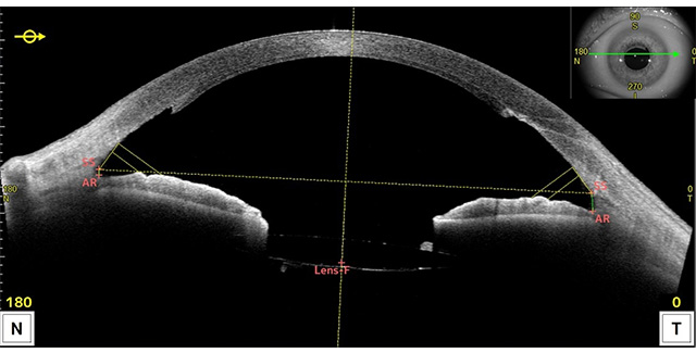 角膜内皮移植後の断面図