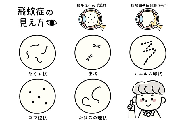 飛蚊症の見え方