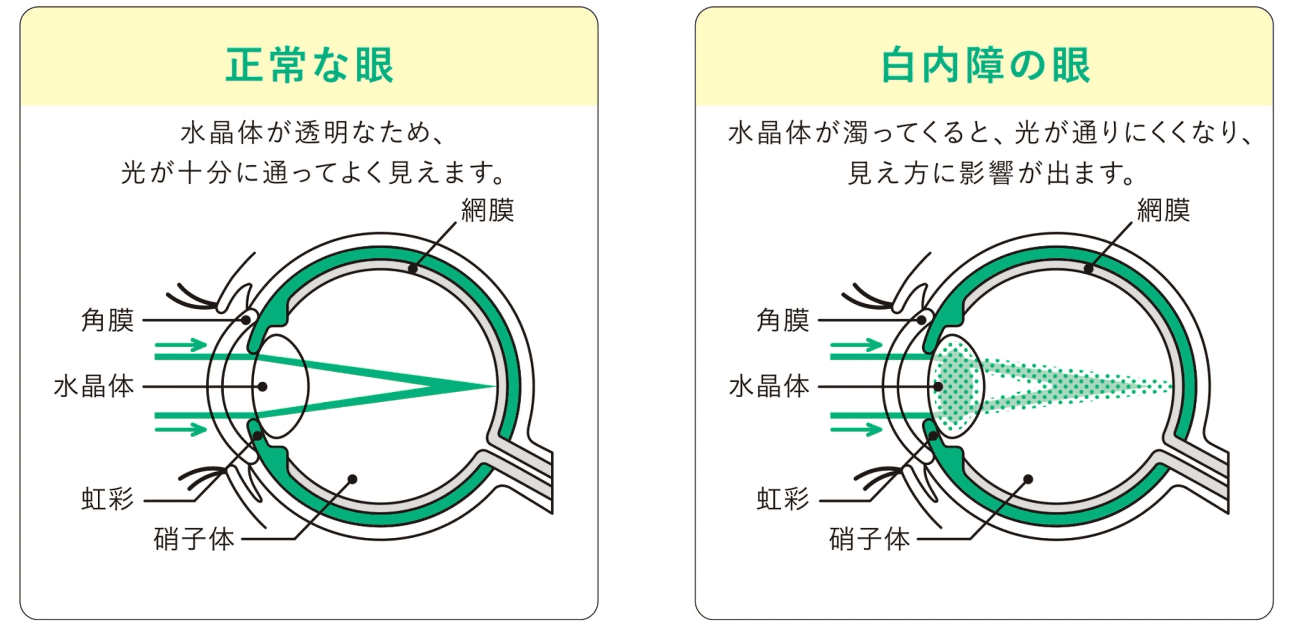 正常な眼と白内障の眼の比較